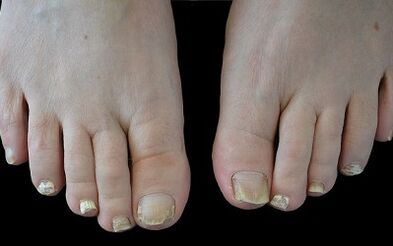 Jak se zbavit houby na prstech