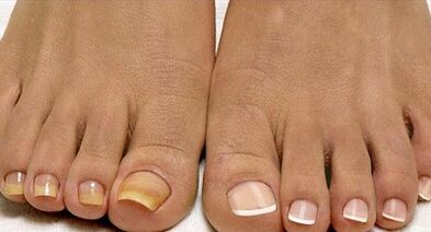 Metody léčby houby flotily