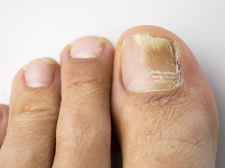 Počáteční fáze houby